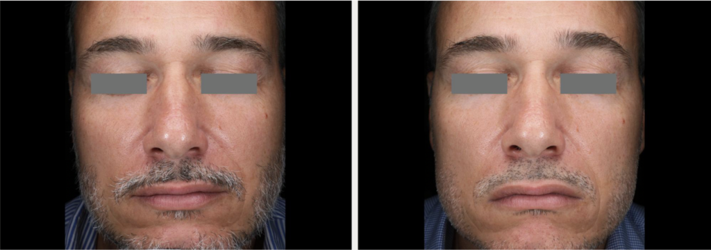 Glace Facial before and after result showing calmer-looking facial redness and a smoother glow