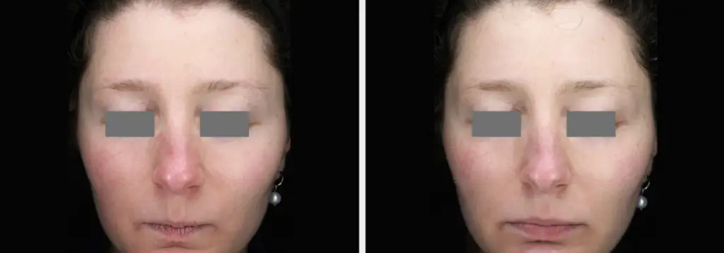 Glace Facial before and after result showing a refreshed, more even-looking complexion